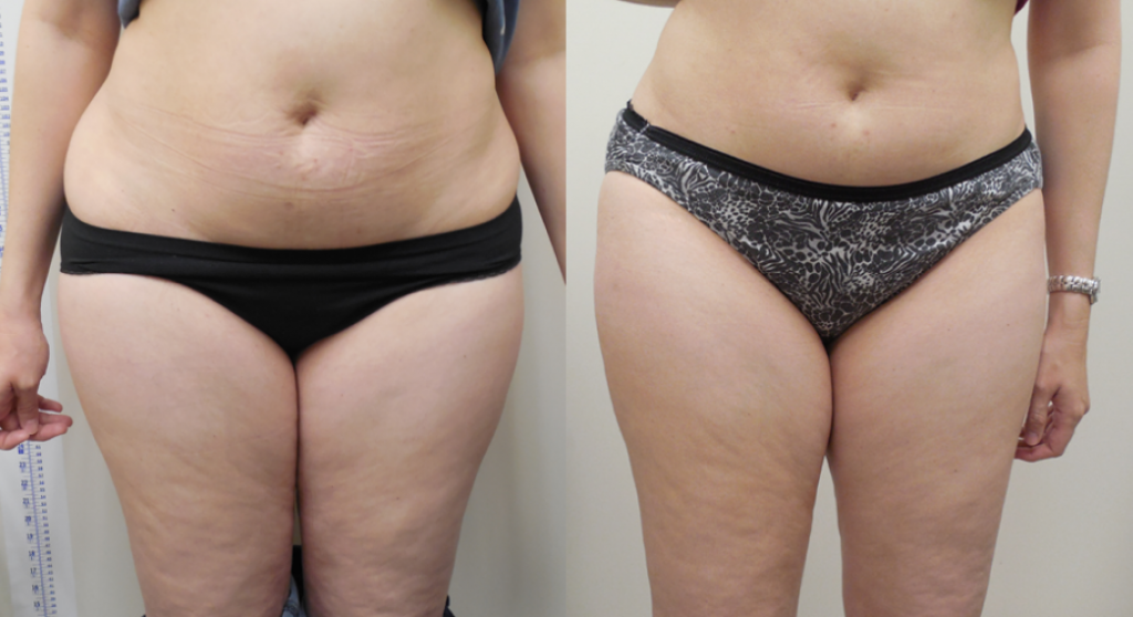 Výsledky laserové liposukce Verjú